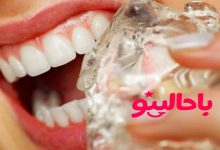 پوسیدگی دندان